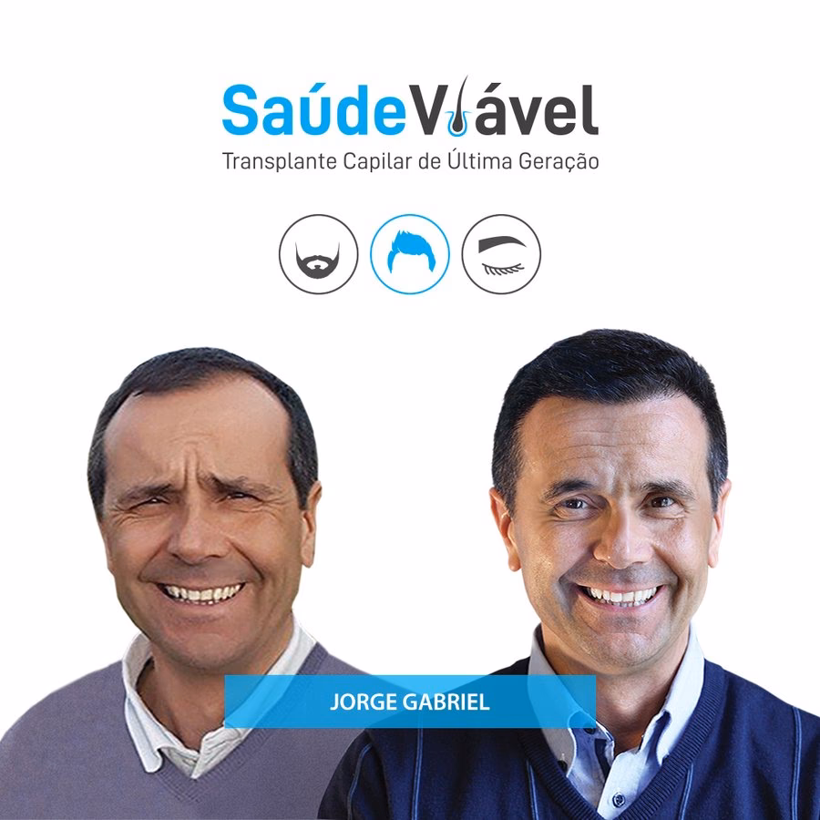 O que pode correr mal num transplante capilar?