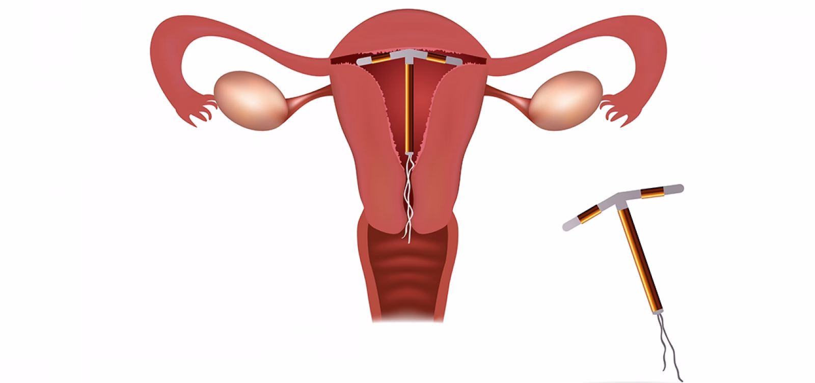 Quais são as vantagens e as desvantagens do uso do DIU?