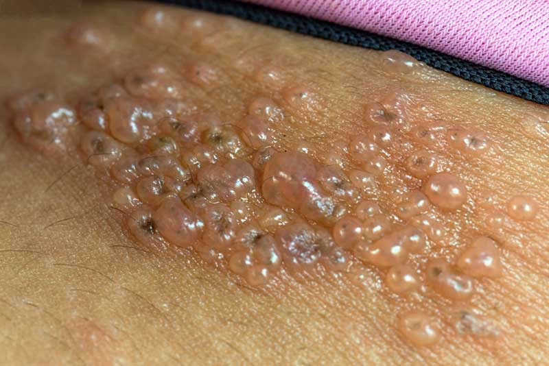 Quais as sequelas que o vírus da zona pode deixar?